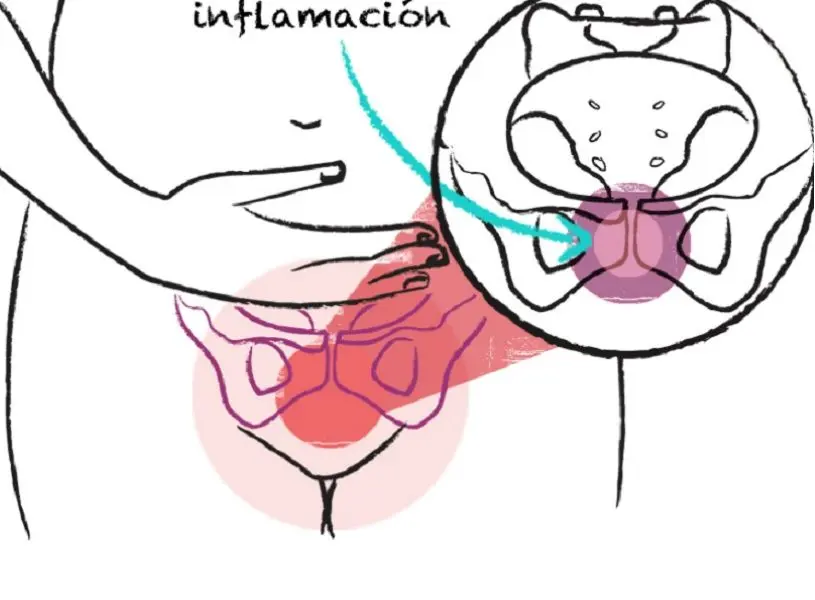 Dolor pubis en embarazo