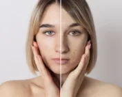 cómo eliminar melasma definitivamente