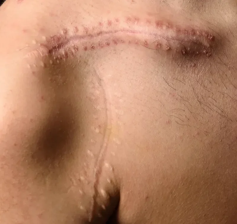 Terapia manual para cicatrices en clínica de fisioterapia en Málaga